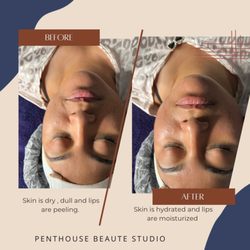 Penthouse Beaute - Microdermabrasion Facial