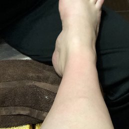 A small glimpse of how red my legs were, they hadn't even finished and I was this red. It continued to develop.