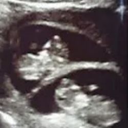 Sono Spotlight 3D Mobile Ultrasound - Twins quick peek