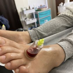 Hijama Cupping Therapy
