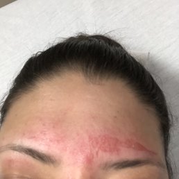 Skin tear in forehead and over eye