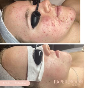 Paper Moon Beauty - Face Reality Acne Bootcamp 4 month progress - Threading Services Near Me - Scotts Valley, California Paper Moon Beauty - Face Reality Acne Bootcamp 4 month progress - Threading Services Near Me - Scotts Valley, California