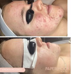 Paper Moon Beauty - Face Reality Acne Bootcamp 4 month progress