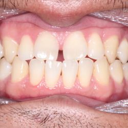 San Carlos Orthodontics - Before
