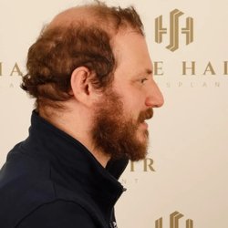 Sule Hair Transplant - Right profile: pre-op photo & surgery 19 Jan 2026. Sule Hair Clinic, Istanbul. See 8-month follow-up in gallery. Results vary.