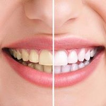 BodyBrite St Johns - Whiten your teeth up to 8 shades lighter - teeth whitening just $129. - Laser Hair Removal Near Me - Saint Johns, Florida BodyBrite St Johns - Whiten your teeth up to 8 shades lighter - teeth whitening just $129. - Laser Hair Removal Near Me - Saint Johns, Florida