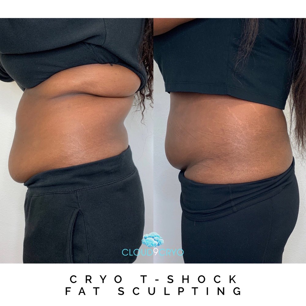Cloud9Cryo - Just 3 sessions! So excited to see my final Results! - Cryotherapy Near Me - Long Beach, California Cloud9Cryo - Just 3 sessions! So excited to see my final Results! - Cryotherapy Near Me - Long Beach, California