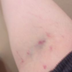 All Family Dental & Braces - Arm 2 scars