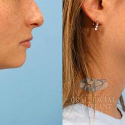 Virginia Advanced Surgical Arts - Genioplasty