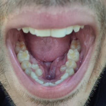 Jin Huh, DMD DDS PhD - Getting my supernumerary teeth out!! - Orthodontists Near Me - Burnaby, British Columbia