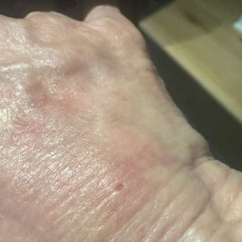 Kenzi MedSpa and Wellness Center - Pin prick entrance for cannula for filler. - Medical Spas Near Me - Naples, Florida Kenzi MedSpa and Wellness Center - Pin prick entrance for cannula for filler. - Medical Spas Near Me - Naples, Florida