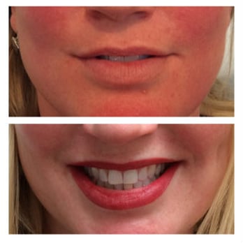 Prettyology - Lips before & immediately after semi permanent makeup by Prettyology. Pigments soften after a few days. - Permanent Makeup Near Me - Peabody, Massachusetts