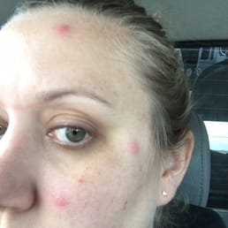 3 of 26 BED BUG BITES at the Catalina Inn! 3 of 26 BED BUG BITES at the Catalina Inn!