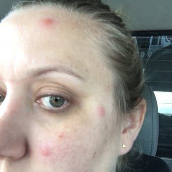 Catalina Inn - 3 of 26 BED BUG BITES at the Catalina Inn! - Hotels Near Me - Tucson, Arizona Catalina Inn - 3 of 26 BED BUG BITES at the Catalina Inn! - Hotels Near Me - Tucson, Arizona