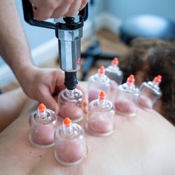 Emerge Holistics - Cupping therapy for back pain - ask about acupuncture and TCM treatments - we do take several insurance plans!