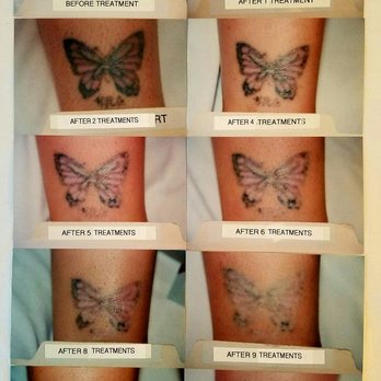 Smooth - Violet and blue butterfly on ankle. Will take time. - Hair Removal Near Me - Brooklyn, New York Smooth - Violet and blue butterfly on ankle. Will take time. - Hair Removal Near Me - Brooklyn, New York