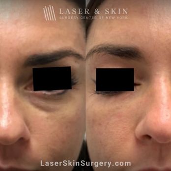 Laser & Skin - Filler Injections Under the Eye to Treat Discoloration - Dermatologists Near Me - Devon, Pennsylvania Laser & Skin - Filler Injections Under the Eye to Treat Discoloration - Dermatologists Near Me - Devon, Pennsylvania