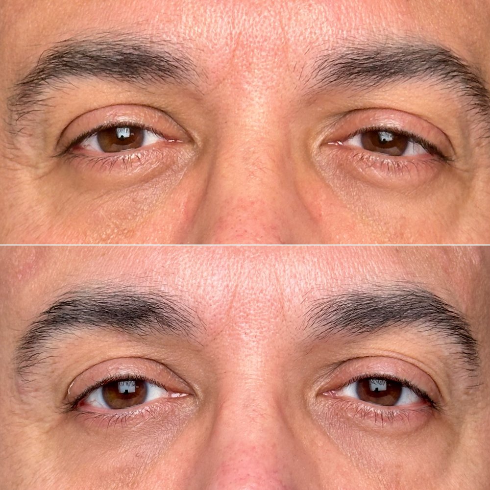 Fibroblast Facelift - Skin Care Near Me - Pasadena, California