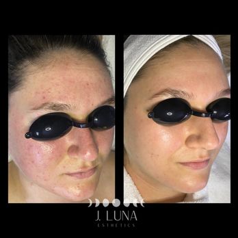 J. Luna Esthetics - Acne Program - Skin Care Near Me - Riverside, California J. Luna Esthetics - Acne Program - Skin Care Near Me - Riverside, California