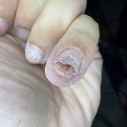 Houston Methodist Primary Care Group - Chemical burn and nails separating and falling off