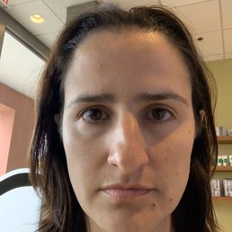 Before treatment. I have brown spots on my cheeks. Before treatment. I have brown spots on my cheeks.