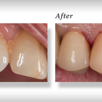 Fred Chao, DDS - Severely fractured tooth replaced with all porcelain crown (view from the side). - General Dentistry Near Me - Los Angeles, California Fred Chao, DDS - Severely fractured tooth replaced with all porcelain crown (view from the side). - General Dentistry Near Me - Los Angeles, California