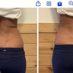 KCryoskin - Before and after