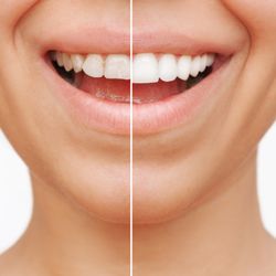 Route 40 Family Dental - Beautiful Porcelain Veneers