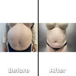Sculpt Body Lounge - After 6 Laser Lipo Treatments. Results vary per client.