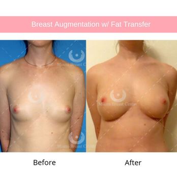 Miami Breast Center - Before and after breast augmentation with fat transfer. - Surgeons Near Me - Key Biscayne, Florida Miami Breast Center - Before and after breast augmentation with fat transfer. - Surgeons Near Me - Key Biscayne, Florida