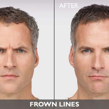 Brian M. Brown MD - BOTOX is the ONLY approved treatment to temporarily reduce and improve the appearance of fine lines and wrinkles, between eyebrows and crows - Ophthalmologists Near Me - Downey, California Brian M. Brown MD - BOTOX is the ONLY approved treatment to temporarily reduce and improve the appearance of fine lines and wrinkles, between eyebrows and crows - Ophthalmologists Near Me - Downey, California