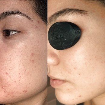 Skintegrity Integrative Skincare - Before/ After - Skin Care Near Me - Glendale, California Skintegrity Integrative Skincare - Before/ After - Skin Care Near Me - Glendale, California