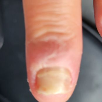 La Beaute Nails - Monday how my finger looked - Nail Salons Near Me - San Dimas, California La Beaute Nails - Monday how my finger looked - Nail Salons Near Me - San Dimas, California