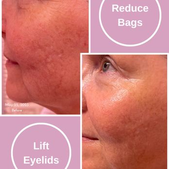 Puritie Spa & Studios - *ADVANCED PLASMA THERAPY* Reduce Bags, Lift Eyelids - Massage Near Me - New Hope, Pennsylvania