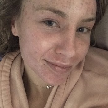 Sublime MD - This is Day 5 and I the skin on my face feels like a baby's ass - Laser Hair Removal Near Me - Mission Viejo, California