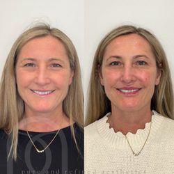 The Laser Image - Upper Face Tox & Lip Filler by Winnie at PARA *patient results photographed at 2 week follow up