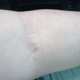 See not bad . No bruise that's just my vein haha!