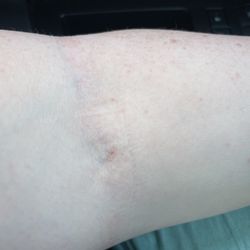 Labcorp - See not bad . No bruise that's just my vein haha!