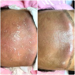 Before and after the Deep Pore Cleansing Facial. Redness will subside after 24 hours. See brighter, smoother, and tighter skin right after.