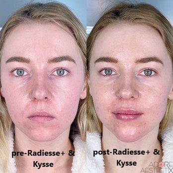 Adore Aesthetix - Amazing transformation w/ 1.5cc Radiesse+ in jawline and chin. Also 1.5 syringe of Kysse in lips - Medical Spas Near Me - Denver, Colorado Adore Aesthetix - Amazing transformation w/ 1.5cc Radiesse+ in jawline and chin. Also 1.5 syringe of Kysse in lips - Medical Spas Near Me - Denver, Colorado