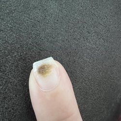 ST Nail Spa - Fungus