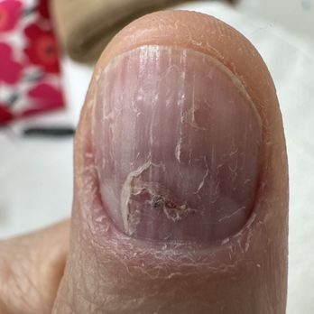 Allure Nail Bar - Damage to natural nail from excessive force with sanding tool. - Nail Salons Near Me - Broomfield, Colorado Allure Nail Bar - Damage to natural nail from excessive force with sanding tool. - Nail Salons Near Me - Broomfield, Colorado