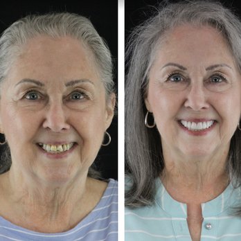 Restoration Dental - Cosmetic dental services available! - General Dentistry Near Me - Winston-Salem, North Carolina Restoration Dental - Cosmetic dental services available! - General Dentistry Near Me - Winston-Salem, North Carolina