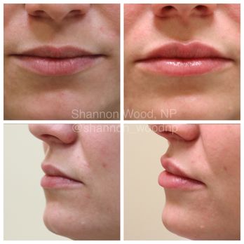 Avani Derm Spa - Lip Filler - Medical Spas Near Me - Des Peres, Missouri
