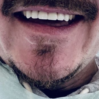 Verde Pointe Dental Associates - At verde point. Finished crowns. - Cosmetic Dentists Near Me - Marietta, Georgia