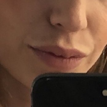 Pickart Plastic Surgery - After second visit, healed/no swelling - Plastic Surgeons Near Me - Ventura, California