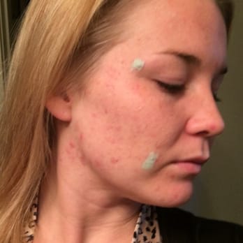 Zara Med Spa - This was after 3 sessions, don't mind my make up lol - Skin Care Near Me - Chula Vista, California Zara Med Spa - This was after 3 sessions, don't mind my make up lol - Skin Care Near Me - Chula Vista, California