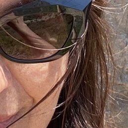 No mole in sight and scar free. Thank you Dr. Ronnie Dawood.