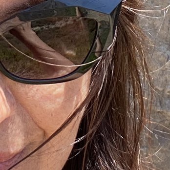 Sublime MD - No mole in sight and scar free. Thank you Dr. Ronnie Dawood. - Laser Hair Removal Near Me - Mission Viejo, California