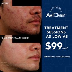 Eden Wellness Spa  - Acne Treatment